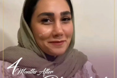 جراحی-بینی-39