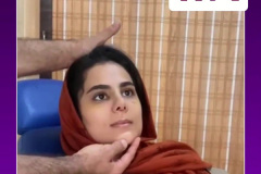 جراحی-بینی-50