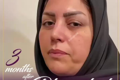 جراحی-بینی-8