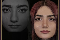 جراحی-بینی-80