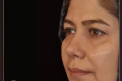 جراحی-بینی-88