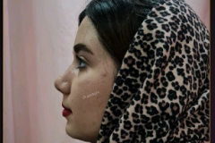 جراحی-بینی-82