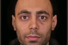 جراحی-بینی-92.1