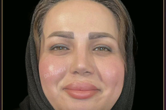 جراحی-بینی-93.1