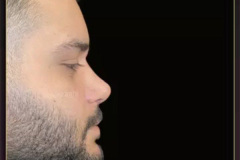 rhinoplasty96.1