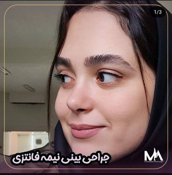 جراحی بینی نیمه فانتزی