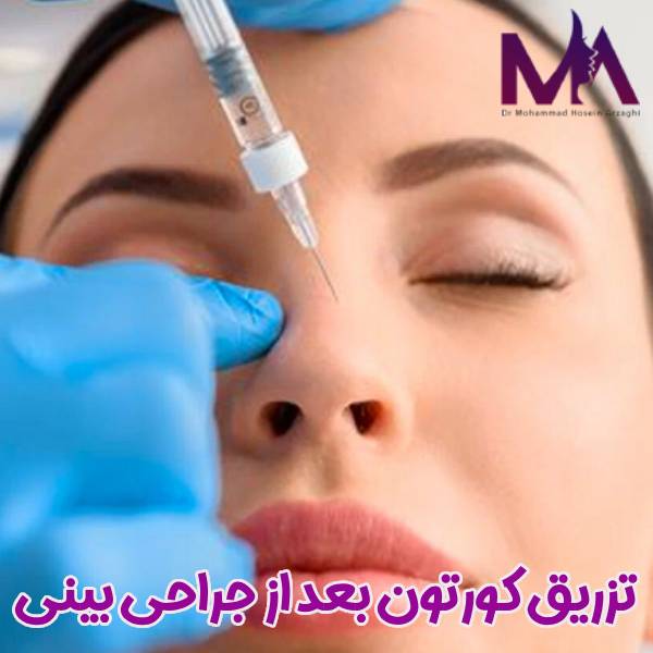 تزریق کورتون بعد جراحی بینی 