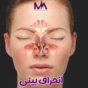 انحراف بینی