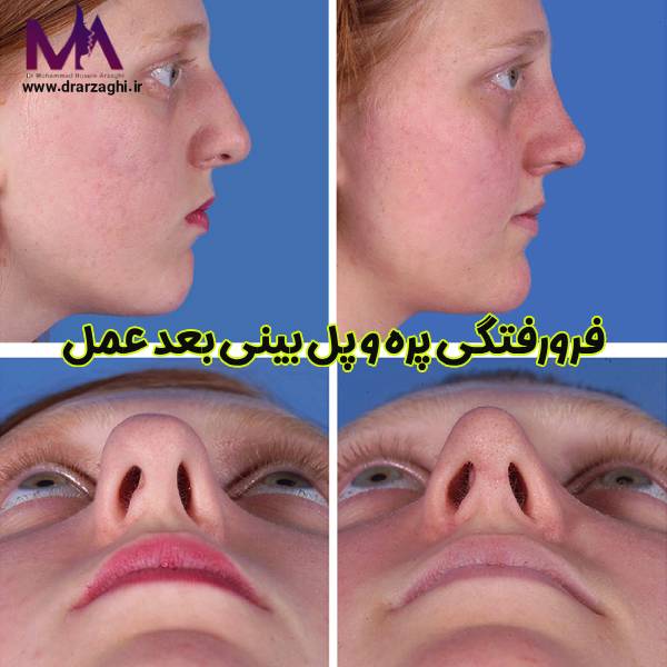 عکس فرو رفتگی پره و پل بینی بعد عمل - دکتر محمدحسین ارزاقی