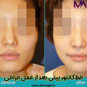خط کانتور بینی بعد از عمل جراحی - دکتر محمدحسین ارزاقی