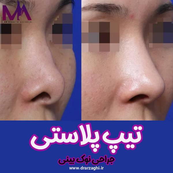 عکس تیپ پلاستی - دکتر محمدحسین ارزاقی