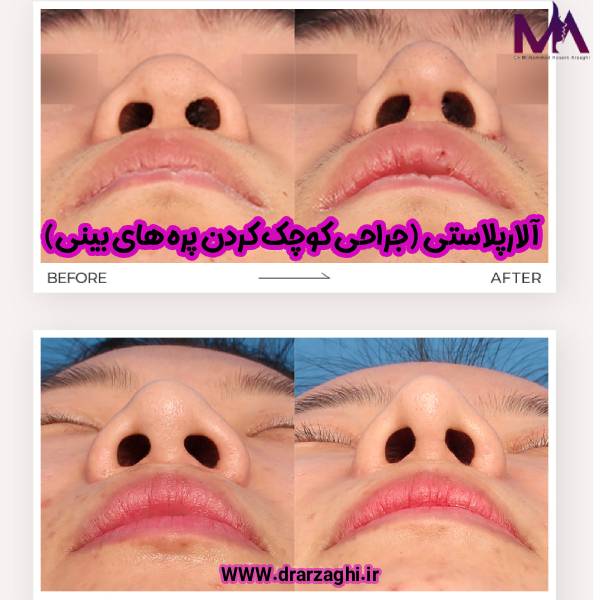 آلارپلاستی - دکتر محمدحسین ارزاقی