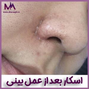 اسکار بعد عمل بینی - دکتر محمدحسین ارزاقی