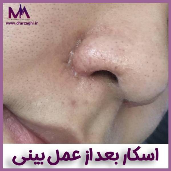 اسکار بعد عمل بینی - دکتر محمدحسین ارزاقی