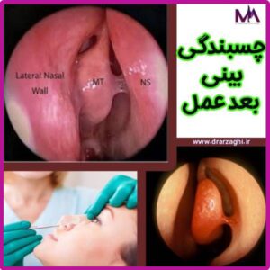 چسبندگی بینی بعد عمل - دکتر محمدحسین ارزاقی