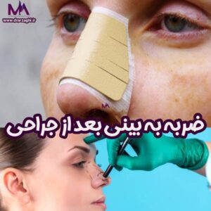 ضربه به بینی عمل شده - دکتر محمدحسین ارزاقی