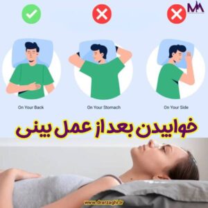 خوابیدن بعد از عمل بینی - دکتر محمدحسین ارزاقی