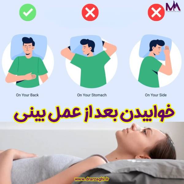 خوابیدن بعد از عمل بینی - دکتر محمدحسین ارزاقی